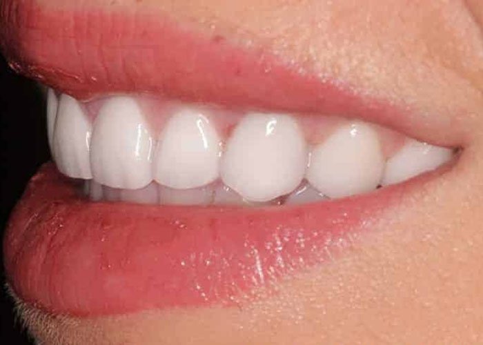 Dental Bonding that is Affordable and Lasts Blog