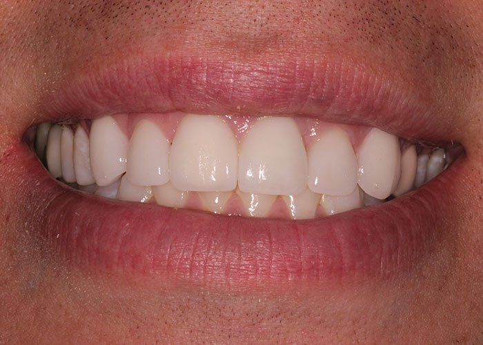 Quality Dental Implants in Los Angeles for the Perfect Smile Blog