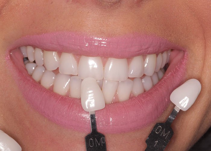 Lasting and Quality Dental Veneers Done in Los Angeles Blog