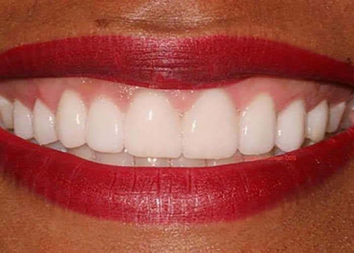 Teeth Whitening for the Perfect Smile Blog