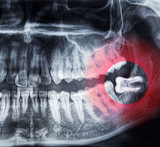 Wisdom Tooth Removal Los Angeles